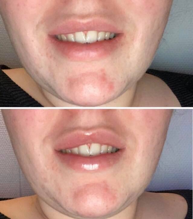 Lip filler serum 5.5 ml