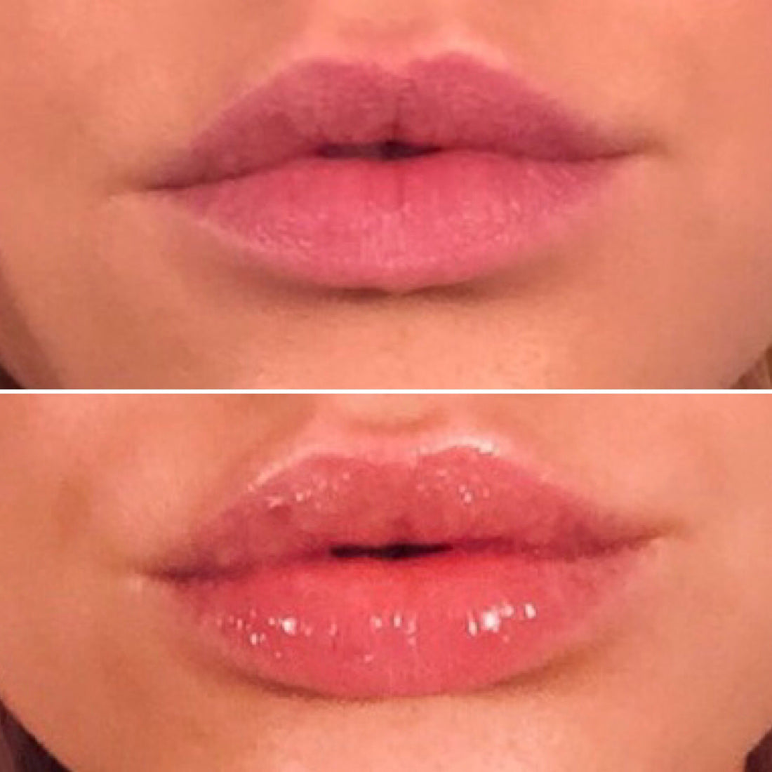 Lip filler serum 5.5 ml