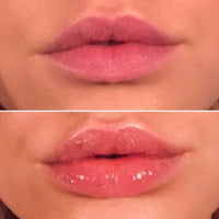 Lip filler serum 5.5 ml