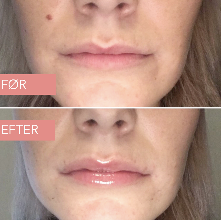 Lip filler serum 5.5 ml