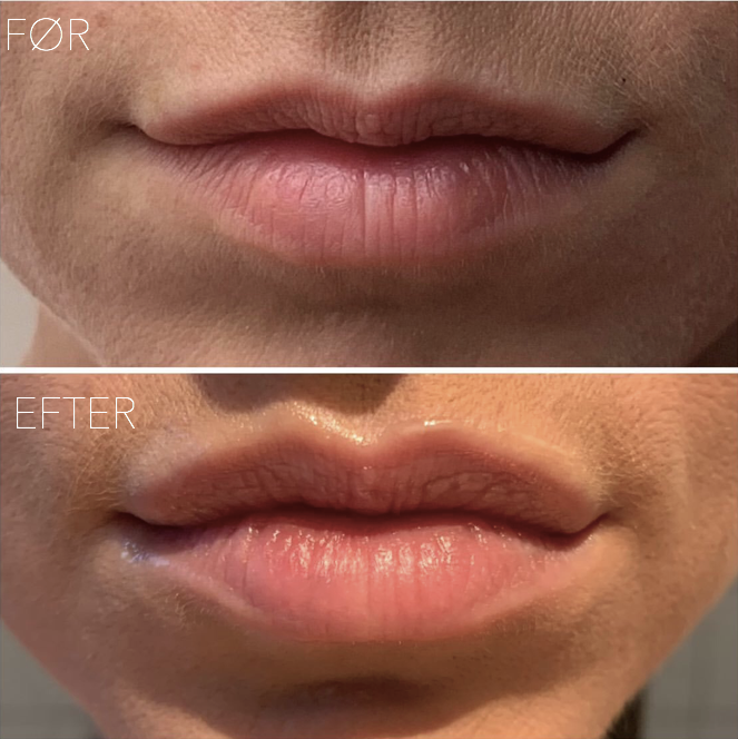 Lip filler serum 5.5 ml